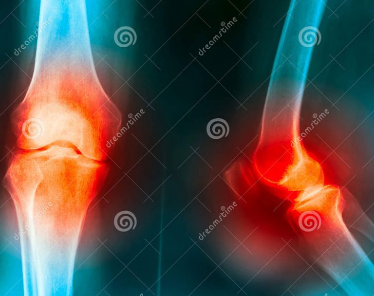 kneejointpaincausetrumagoutrheumatoidosteoarthritis66129528